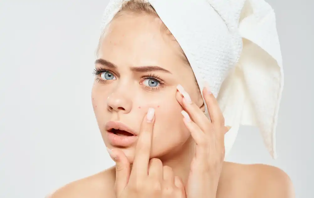 acne treatment
