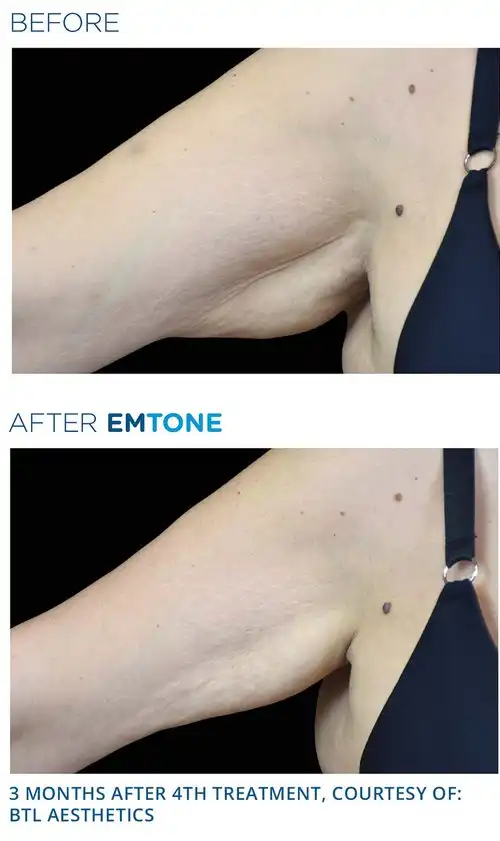 emtone