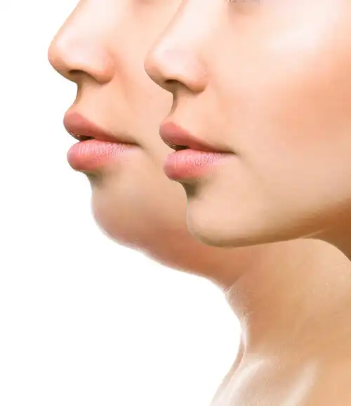 lipolysis double chin