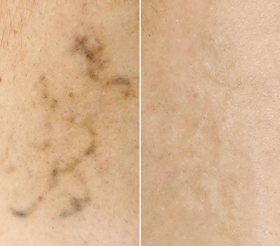 tattoo removal